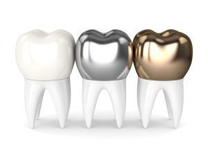 مقایسه انواع قیمت هزینه روکش فلزی، سرامیک، لمینیت دندان در دندانپزشکی