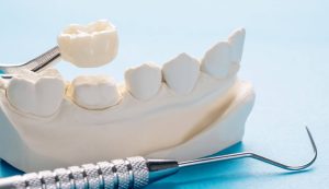 لمینیت کامپوزیت و انواع روکش دندان برای دندان با مقایسه بهترین قیمت و کیفیت