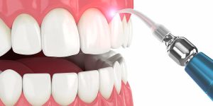 جرم گیری دندان ها به وسیله وسایل جرمگیری دندان توسط لیزر