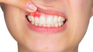 بهترین روش جرم گیری دندان برای دندان های جرمگیری نشده
