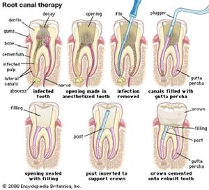 عصب کشی دندان(اندو) با دستگاه اندو روتاری دندانپزشکی 