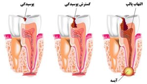 گسترش پوسیدگی دندان در دندانپزشکی