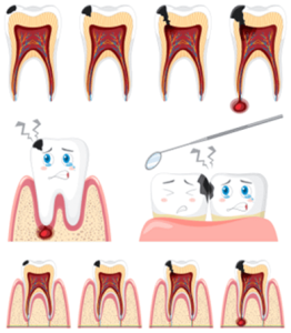 عصب کشی یا اندو برای دندان های پوسیده