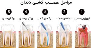مراحل عصب کشی دندان با دستگاه اپکس روتاری دندانپزشکی