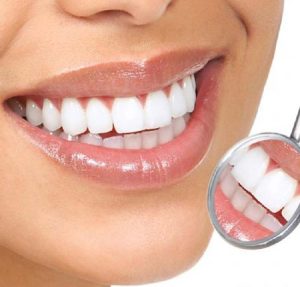 طرح لبخند برای انجام کامپوزیت دندان 