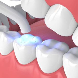 لایت کیور برای خشک و سفت شدن کامپوزیت دندان